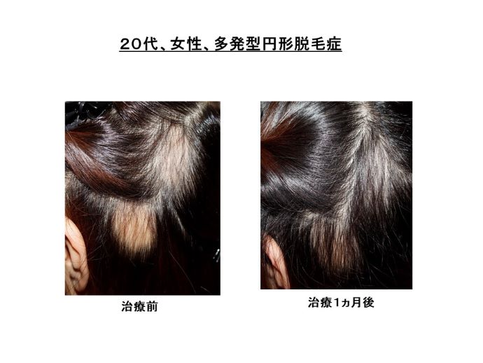 円形脱毛症　病院